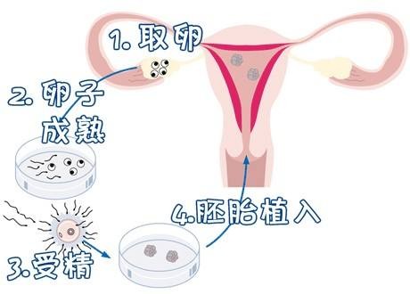 42岁PGT成功案例